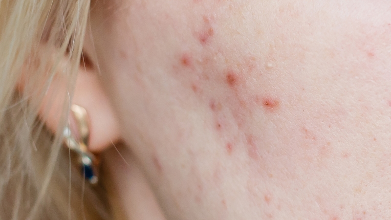 Crvene i upaljene bubuljice na obrazu i vilici žene izbliza