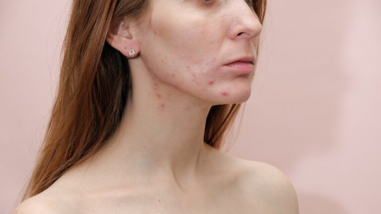 Žena sa crvenim bubuljicama na bradi i duž linije vilice, tipičnim za hormonske bubuljice na licu