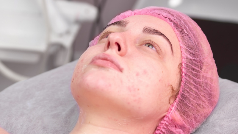 Devojka sa hormonskim bubuljicama na licu tokom dermatološkog tretmana u kozmetičkom salonu