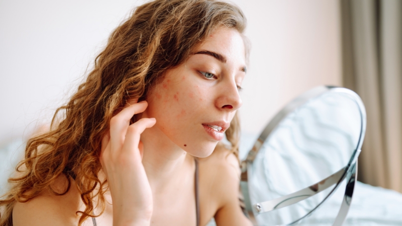 Devojka sa crvenim bubuljicama na obrazu i bradi posmatra kožu u ogledalu